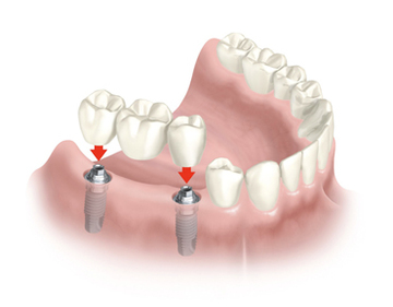 implantes dentales: todo lo que debes saber